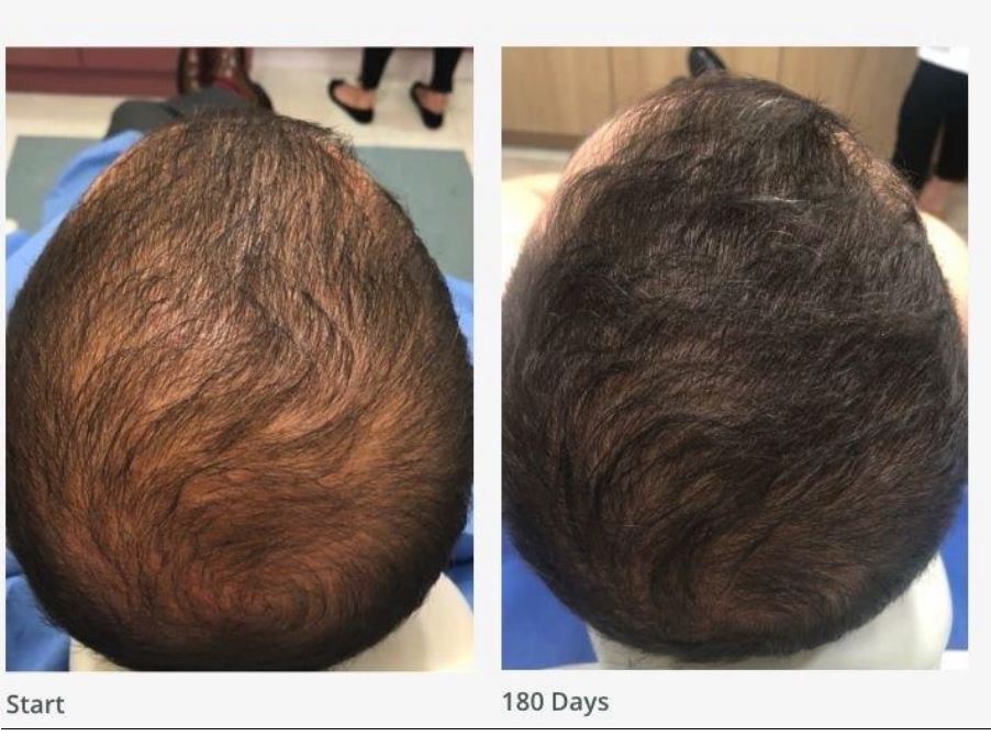 Hairfall Treatment at Glowup Clinic